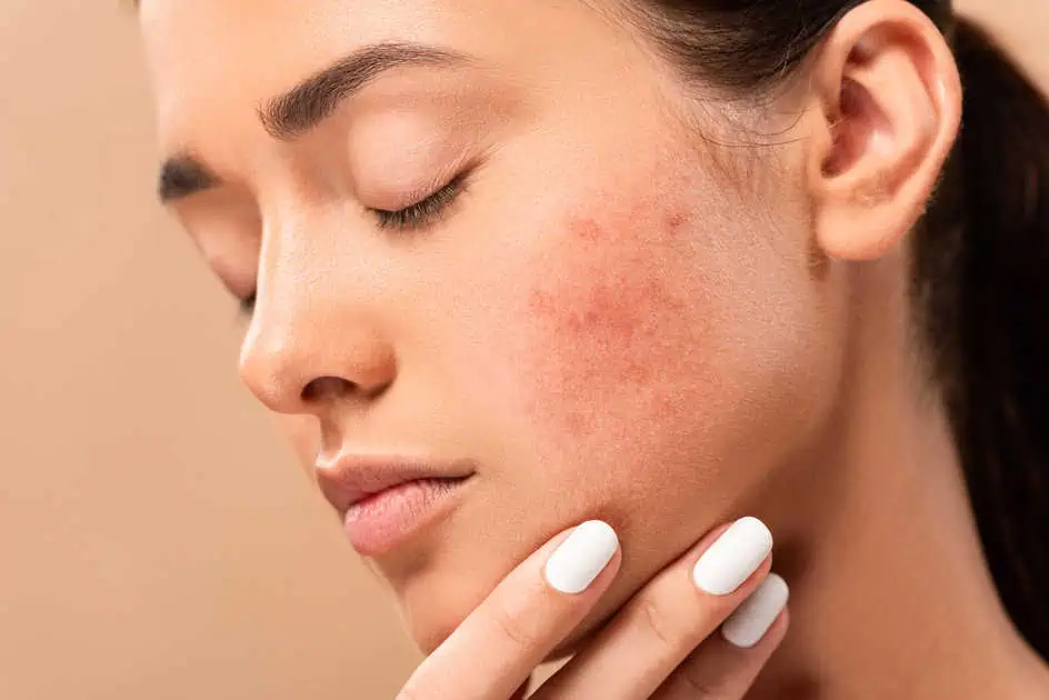 Acne Treatment by Edge Aesthetics & Wellness, LLC in Palm Beach, FL
