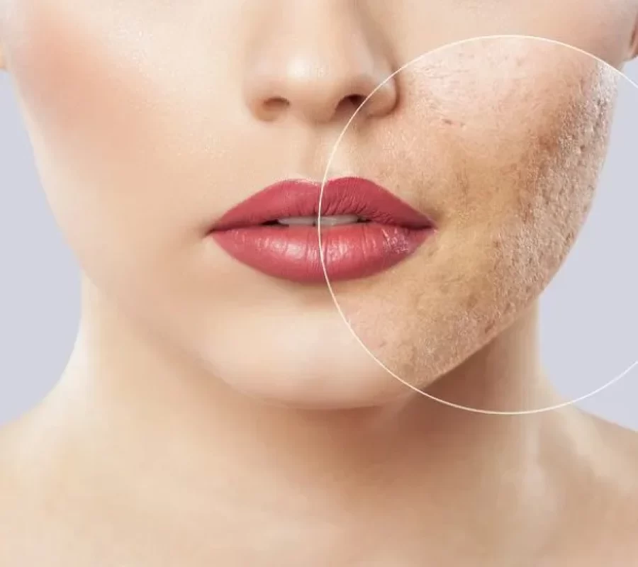 acne-treatments-in-services-by-edge-aesthetics-and-wellness-in-royal-palm-beach-fl