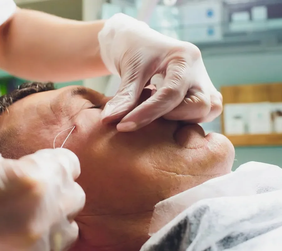 pdo-thread-at-edge-aesthetics-and-wellness-in-royal-palm-beach-fl pdo-thread-at-edge-aesthetics-and-wellness-in-royal-palm-beach-fl